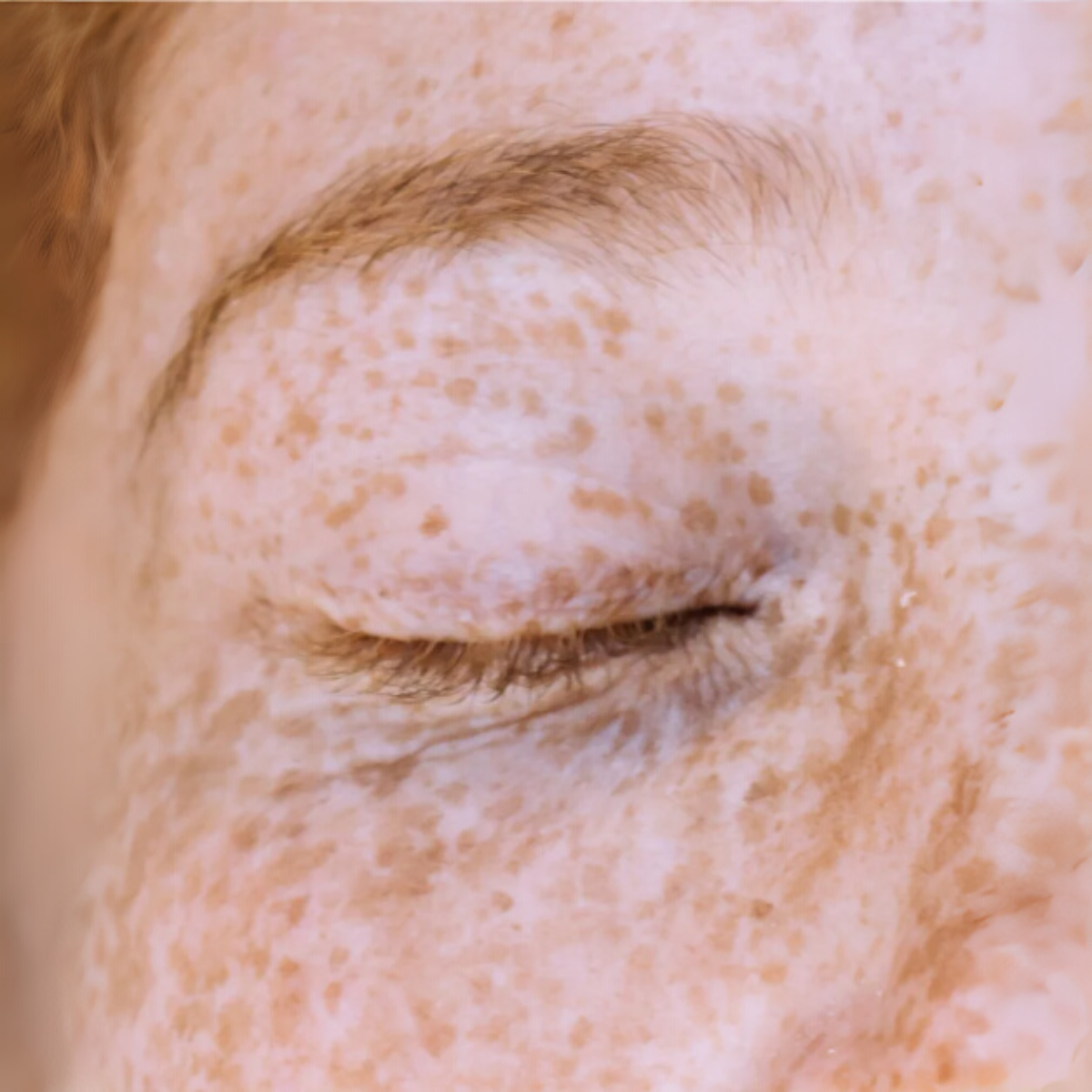 Close-up of a person's eye with visible freckles on the skin.